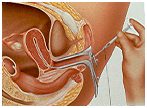 How the IUI procedure is performed